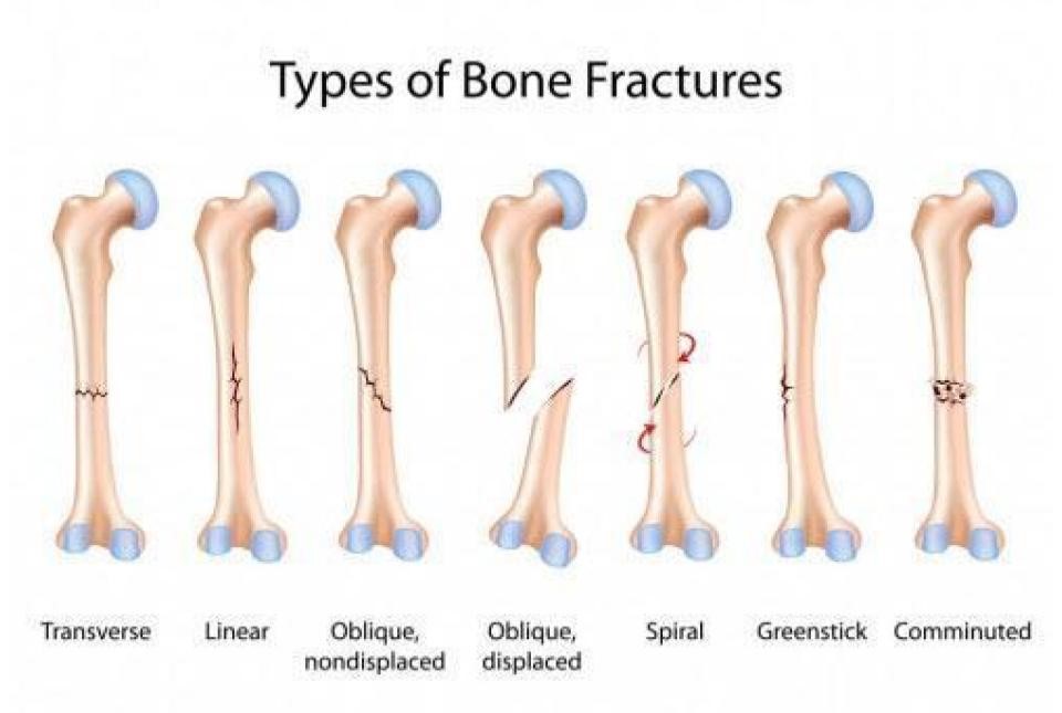 types-of-bone-fractures